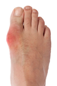 Gout Attack Prevention