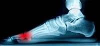 Sesamoid Injuries in the Foot